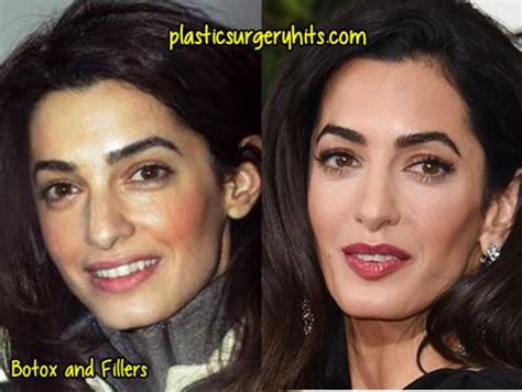 Amal Clooney Plastic Surgery Before and After   Plastic ...