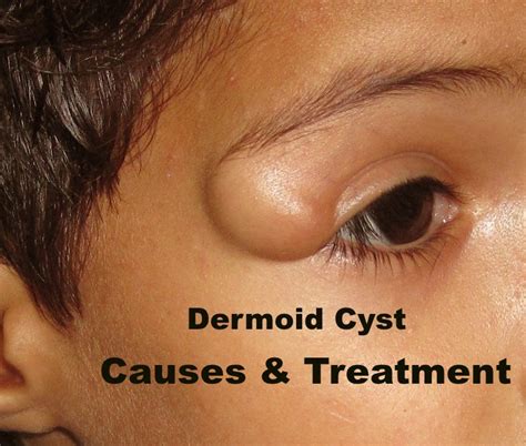 An Overview of Dermoid Cysts | Social Medical Network