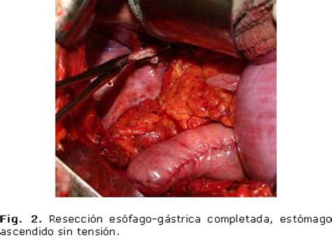 Anastomosis esofagogástrica látero lateral con engrapadora ...