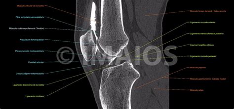 Anatomía de la rodilla  artrografía
