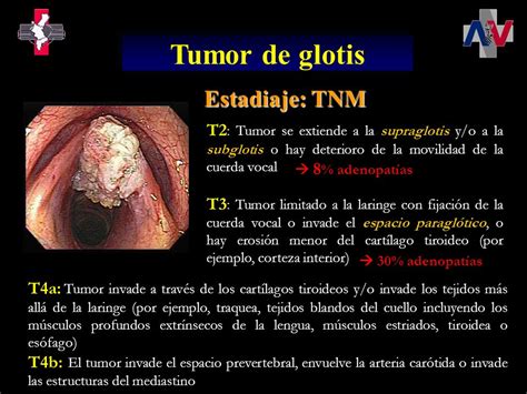Anatomía y estadiaje de los tumores de laringe e ...
