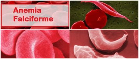 Anemia Falciforme: Causas, Diagnóstico, Síntomas ...