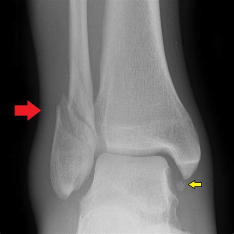 Ankle Fractures  Tibia and Fibula    Musculoskeletal ...