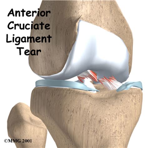 Anterior Cruciate Ligament Injuries | eOrthopod.com