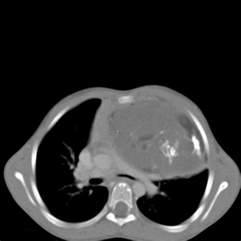 Anterior mediastinal teratoma | Radiology Case ...