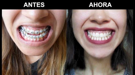 Antes y después, cirugía ortognatica/maxilofacial   YouTube