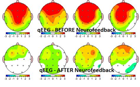 Anxiety: Before and After Neurofeedback Treatment