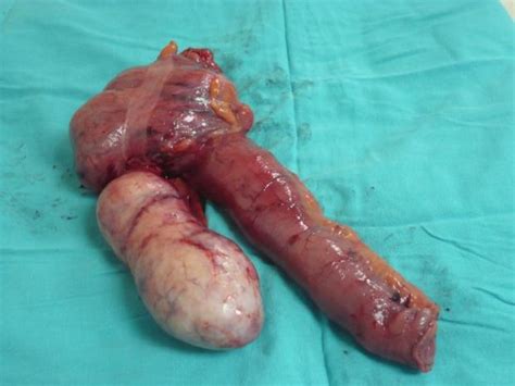 Appendiceal Carcinoid tumor  1 of 3  • Picture • MEDtube.net