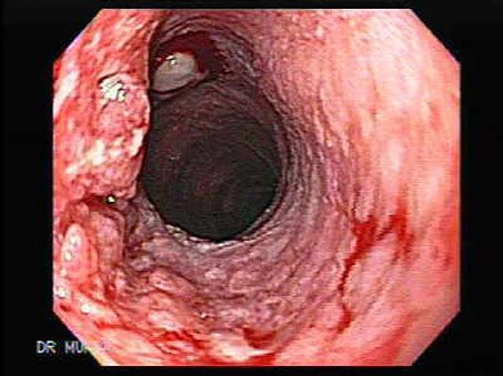 April: Esophageal Cancer   Maravilloso Magazine