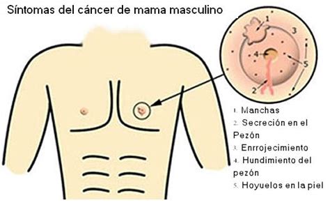 Archivo:Síntomas del cancer de mama masculino.jpg ...