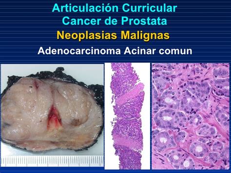 Articulación curricular prostata