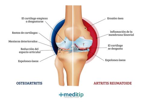 Artritis ¿Qué es la artritis y cuando identificarla?   Meditip