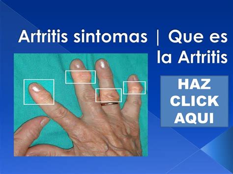 Artritis sintomas | Que es la Artritis   YouTube