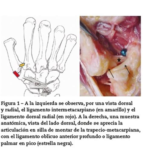 Artrosis de la articulación trapecio metacarpiana ...