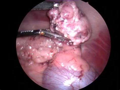 Asportazione tumore ovarico in laparoscopia   YouTube