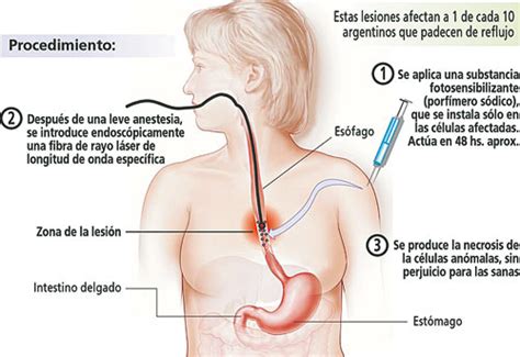 Atacan con láser el tumor de esófago   LA GACETA Tucumán