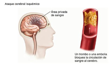 Ataque Isquêmico Transitório; TIA; Isquemia Cerebral ...