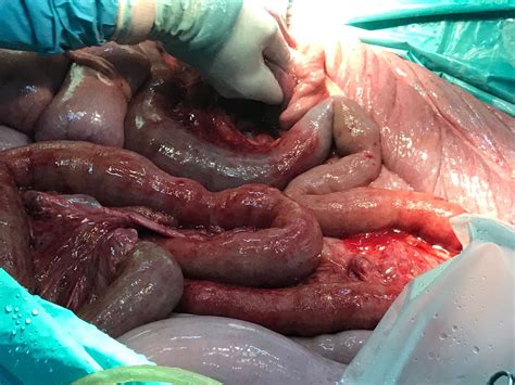Atrapamiento de intestino delgado en Foramen epiploico......