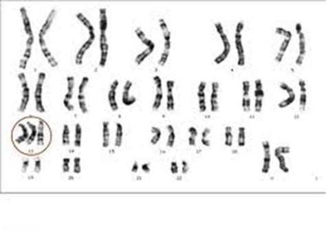 Aulas de Biologia: Aberrações cromossômicas