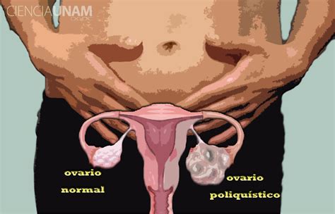 Aumenta la incidencia del Síndrome de Ovario Poliquístico ...