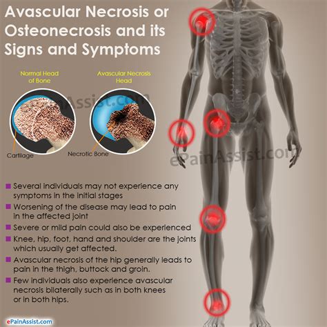 Avascular Necrosis or Osteonecrosis|Types| Epidemiology ...