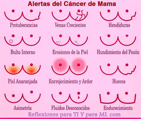 Ayúdate : Síntomas del posible cáncer de mama
