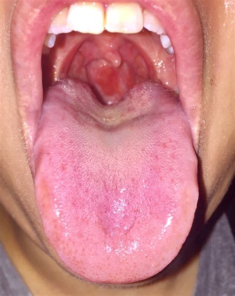 Back Of Tongue Cancer Pictures to Pin on Pinterest   PinsDaddy