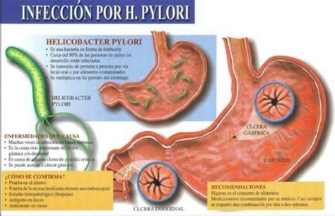 Bacteria Helicobacter Pylori: Síntomas y Tratamiento ...