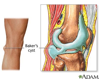 Baker s Cyst. Causes, symptoms, treatment Baker s Cyst