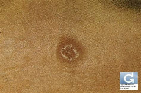 Basal Cell Carcinoma  Photos  « Globale Dermatologie