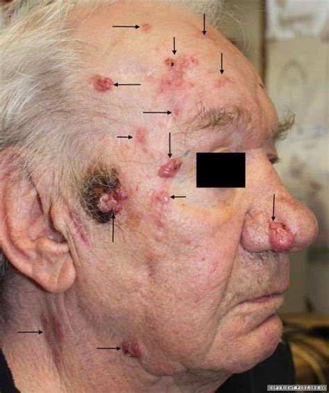 Basal cell carcinoma | Primary Care Dermatology Society | UK
