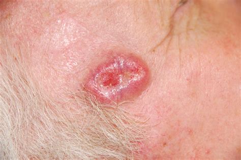 Basal Cell Carcinoma Symptoms, Causes, Diagnosis and ...