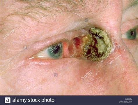 Basal Cell Carcinoma | www.pixshark.com   Images Galleries ...