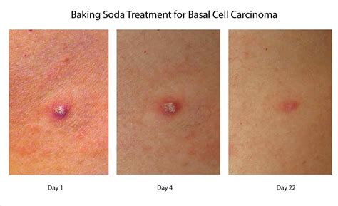 Basalcell Basil Cell Skin Cancer Carcinoma Wikipedia Skin ...