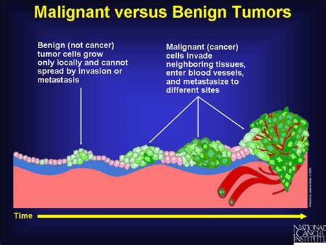 Benign and Malignant Tumors: What is the Difference?