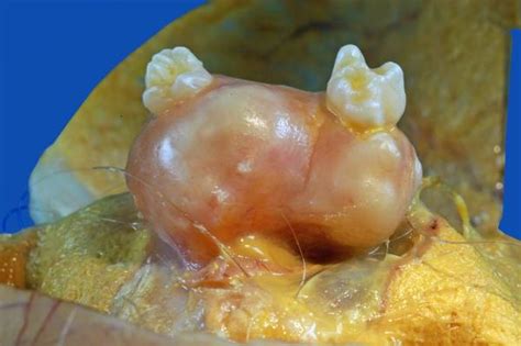 Benign mature teratoma of the ovary  2    DocCheck Pictures