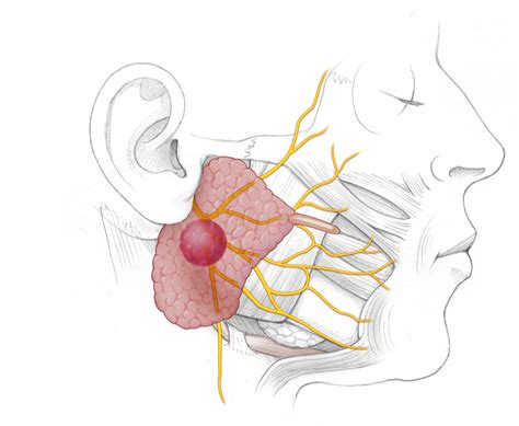 Benign salivary gland tumors | Stanford Health Care