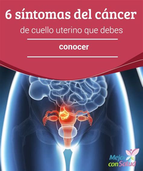 Best 25+ Cancer cuello uterino sintomas ideas on Pinterest ...