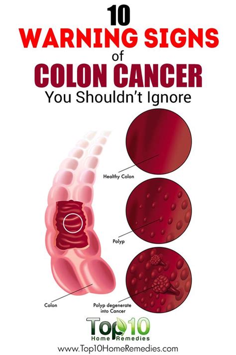 Best 25+ Colon cancer symptoms ideas on Pinterest | Colon ...