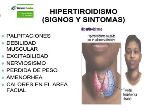 Best 25+ Sintomas del hipertiroidismo ideas on Pinterest ...