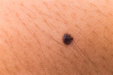 Best Way to Beat Melanoma is to Know the Symptoms – Health ...