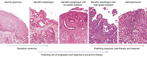 Biomarkers in Barrett’s esophagus and esophageal ...