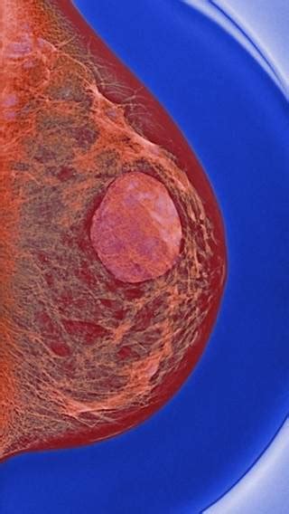 Biopsy all breast cysts? The Clinical Advisor