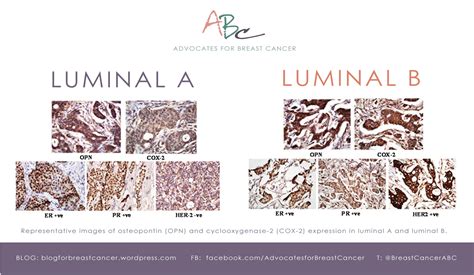 Biopsy Basics: Luminal A & Luminal B – ABC – Advocates For ...