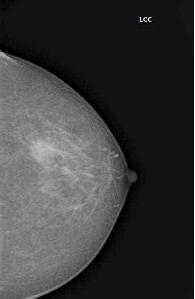 BIRADS II lesion: simple breast cyst | Image | Radiopaedia.org