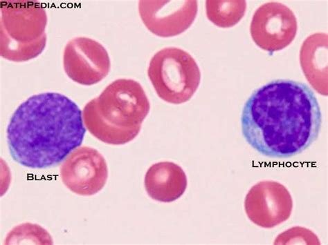 blast cells differentiation   Google Search | Medical ...