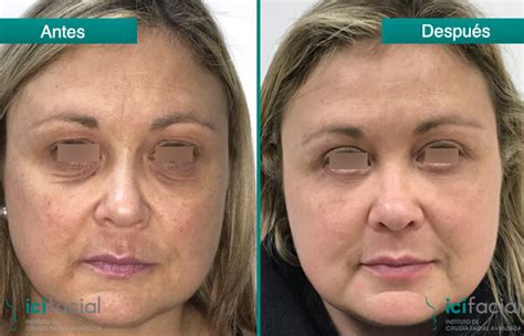 Blefaroplastia fotos antes y después   icifacial.com