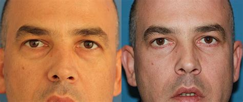 Blefaroplastia, rejuvenecimiento de los párpados masculina