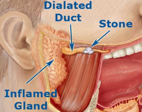 Blocked Salivary Glands   Home Remedies, Symptoms, Treat