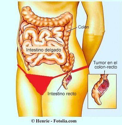 Bloqueo intestinal, sintomas, tratamiento natural y cirugia